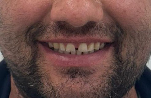 Resultado dental tras el tratamiento estético