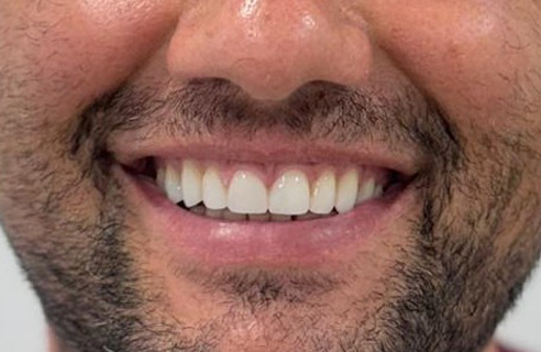 Estado anterior de la sonrisa antes del tratamiento