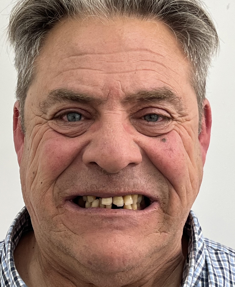 Resultado de rehabilitación fija superior e inferior con implantes dentales