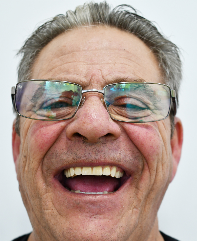 Situación previa a rehabilitación con implantes dentales