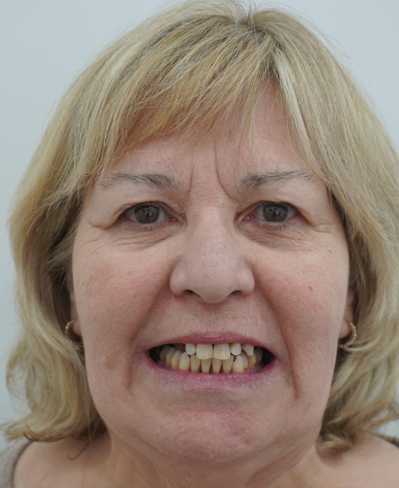 Resultado de tratamiento con sobredentadura sobre implantes dentales