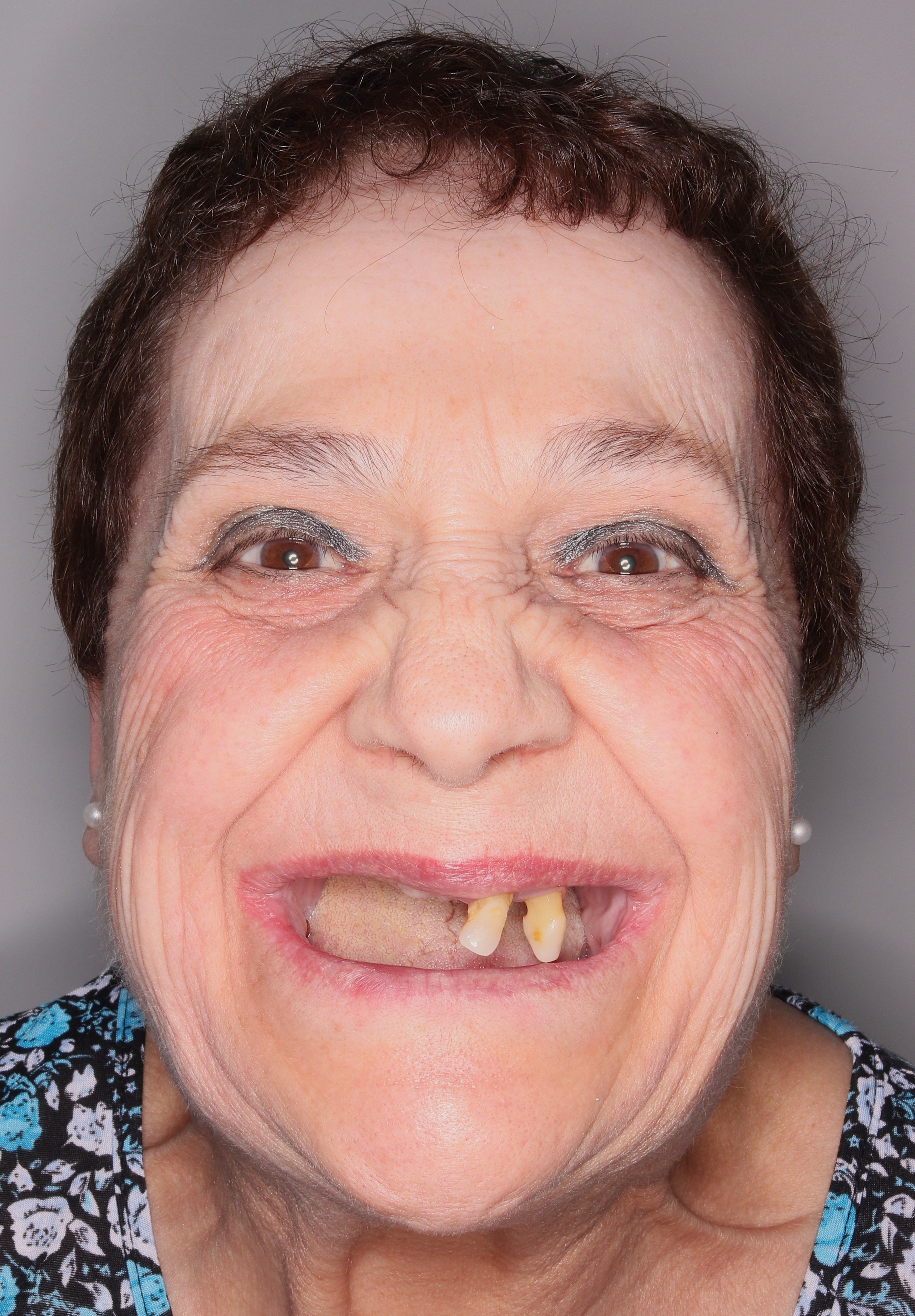 Situación previa a rehabilitación fija con implantes dentales