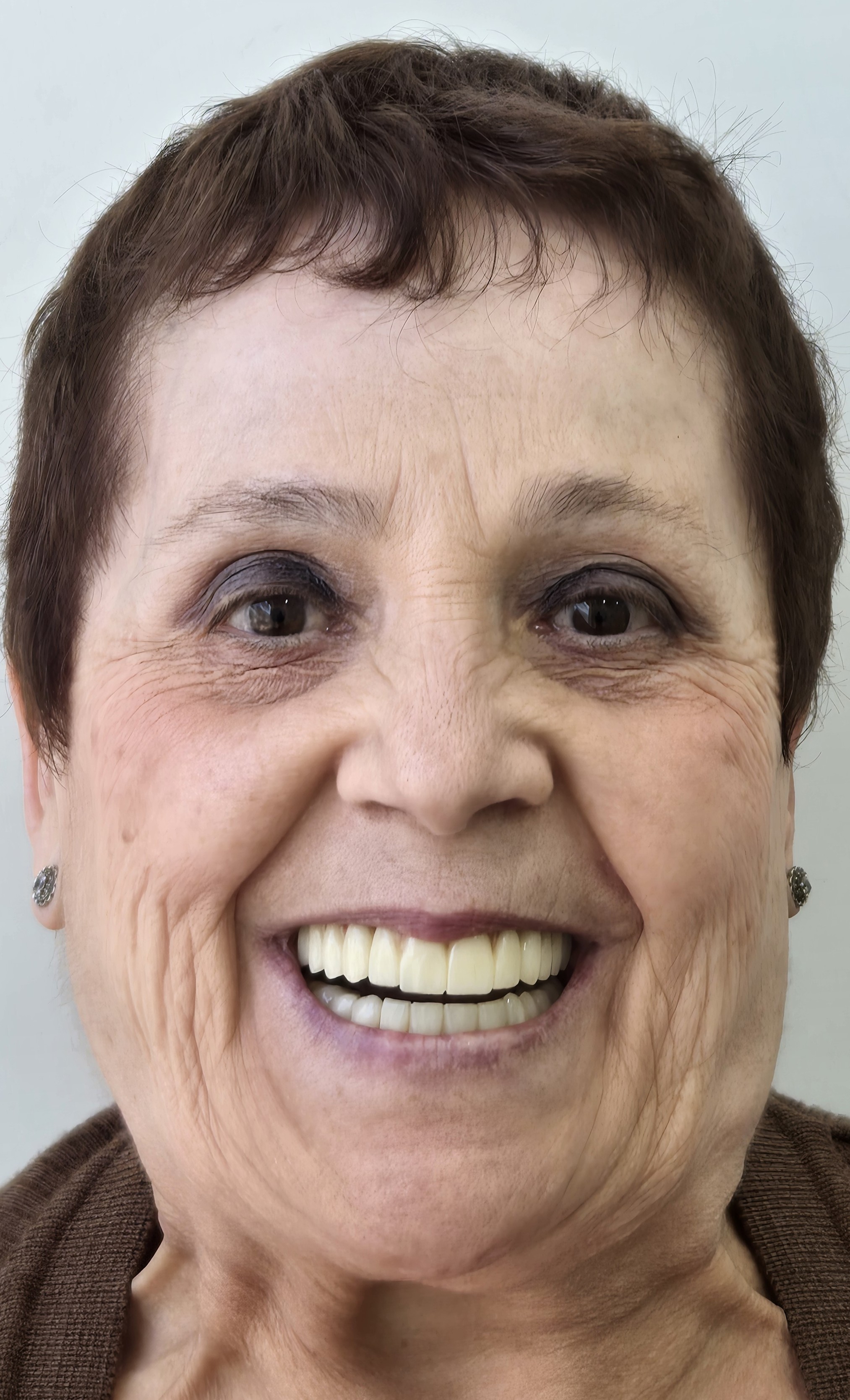 Resultado de rehabilitación fija con implantes dentales en Murcia